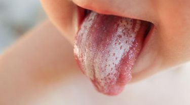 Cara Menghilangkan Bercak Putih Pada Gigi Anak